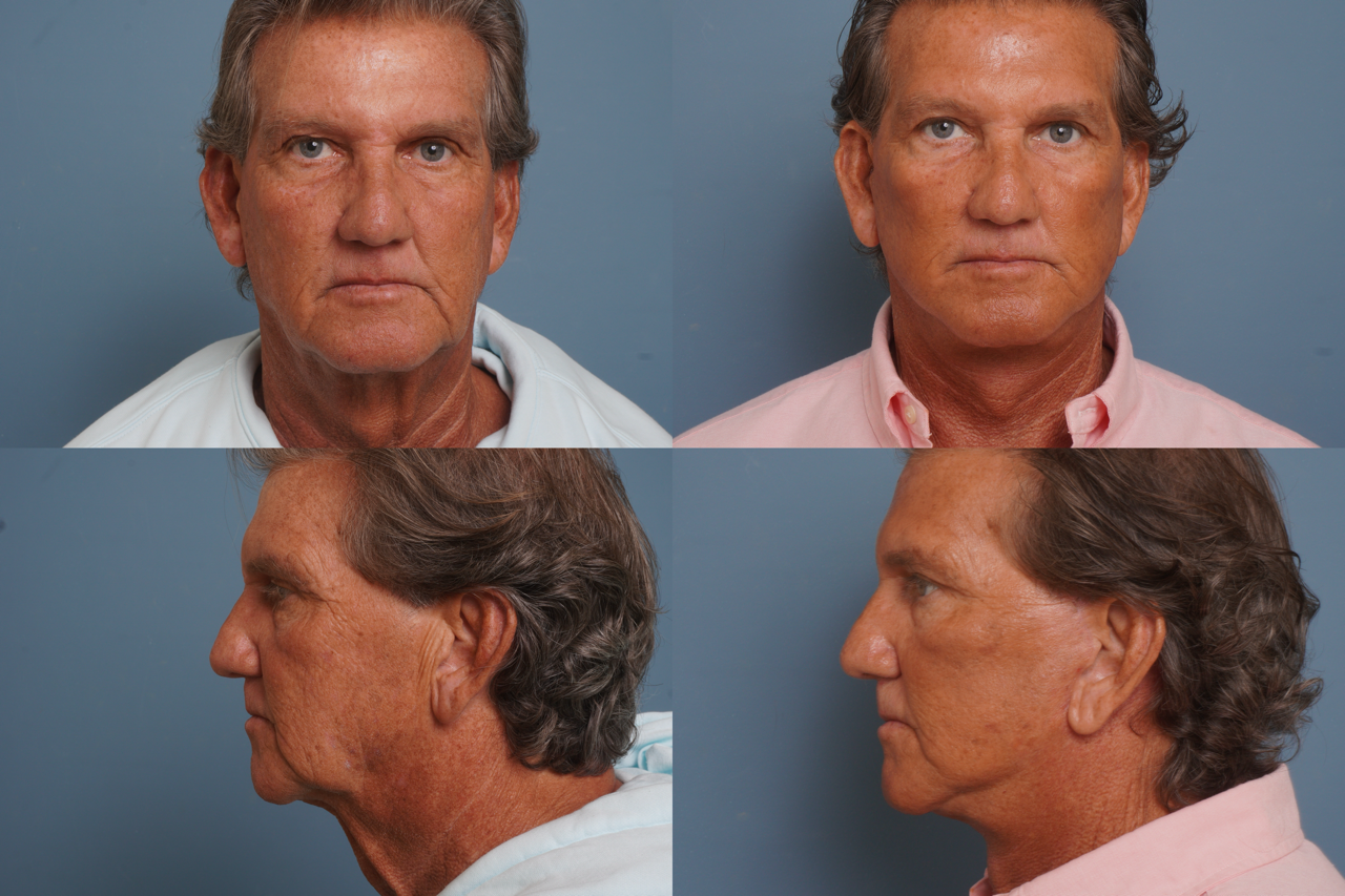 Facelift Before & After