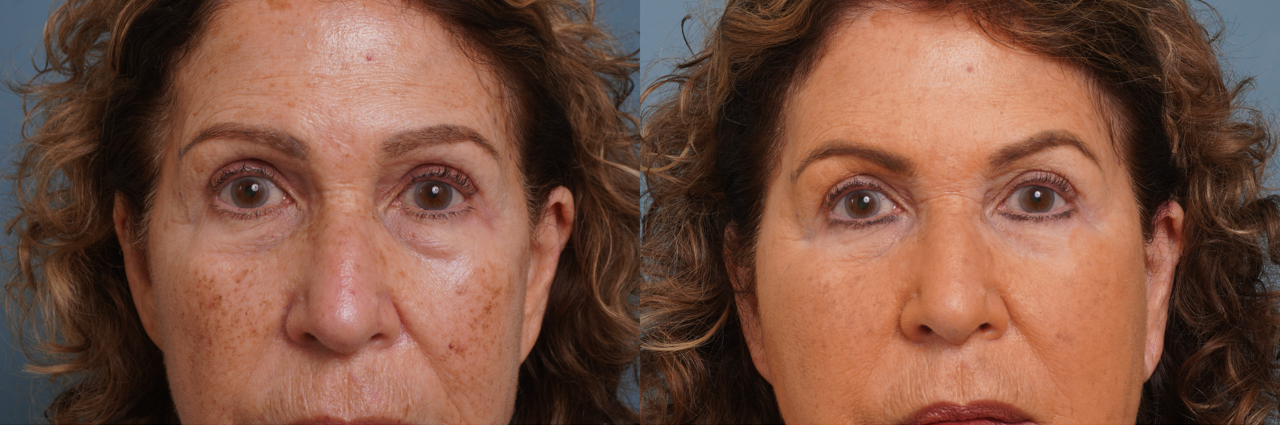 Lower Blepharoplasty B/A