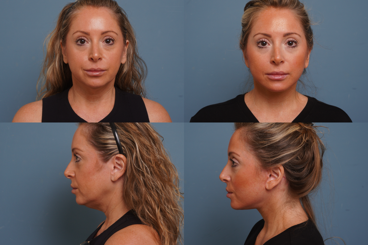 Facelift Before & After