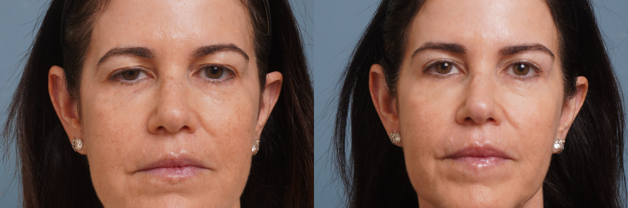 Lower Blepharoplasty B/A