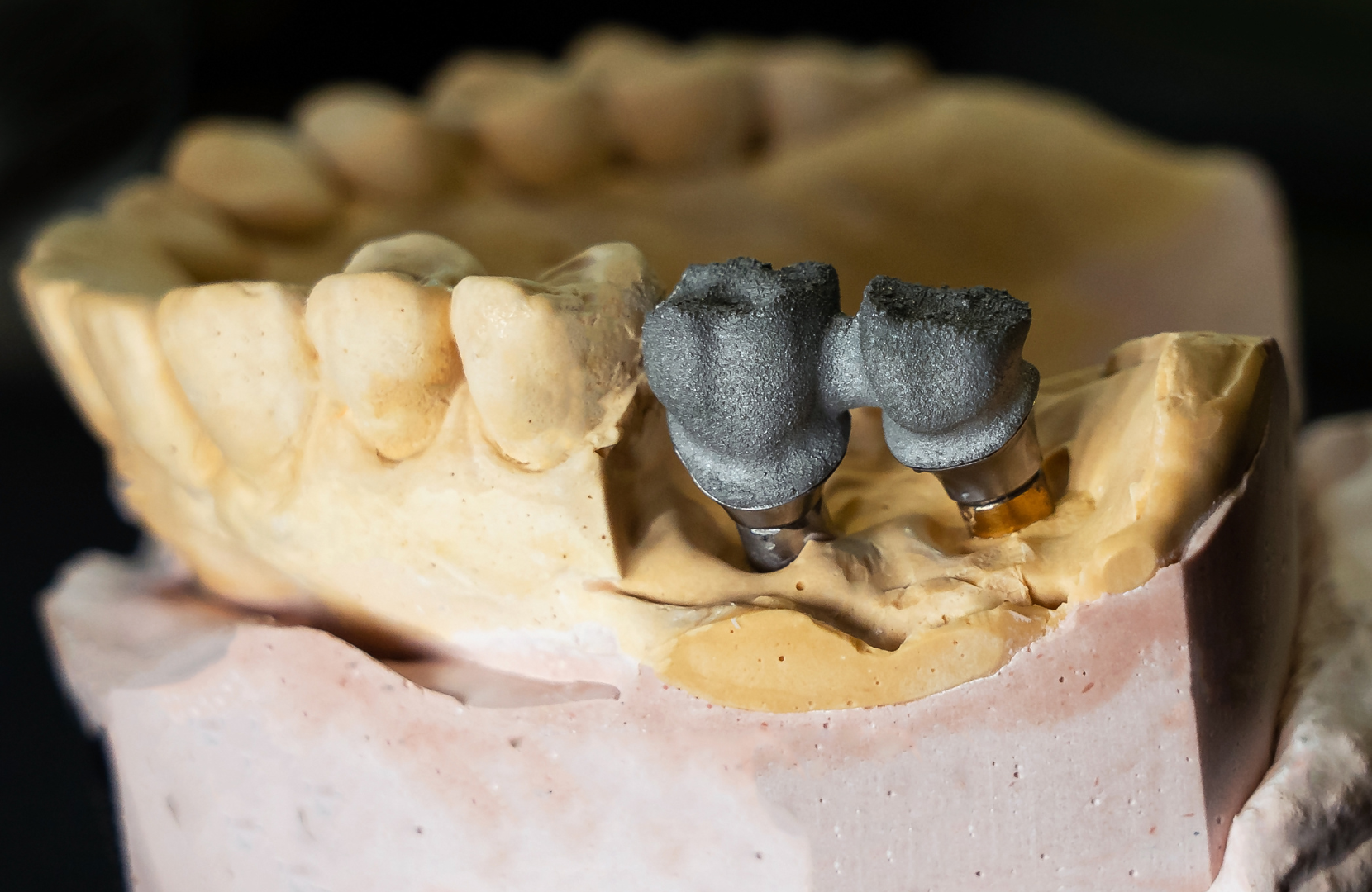 framework for dental crowns by the method of SSL