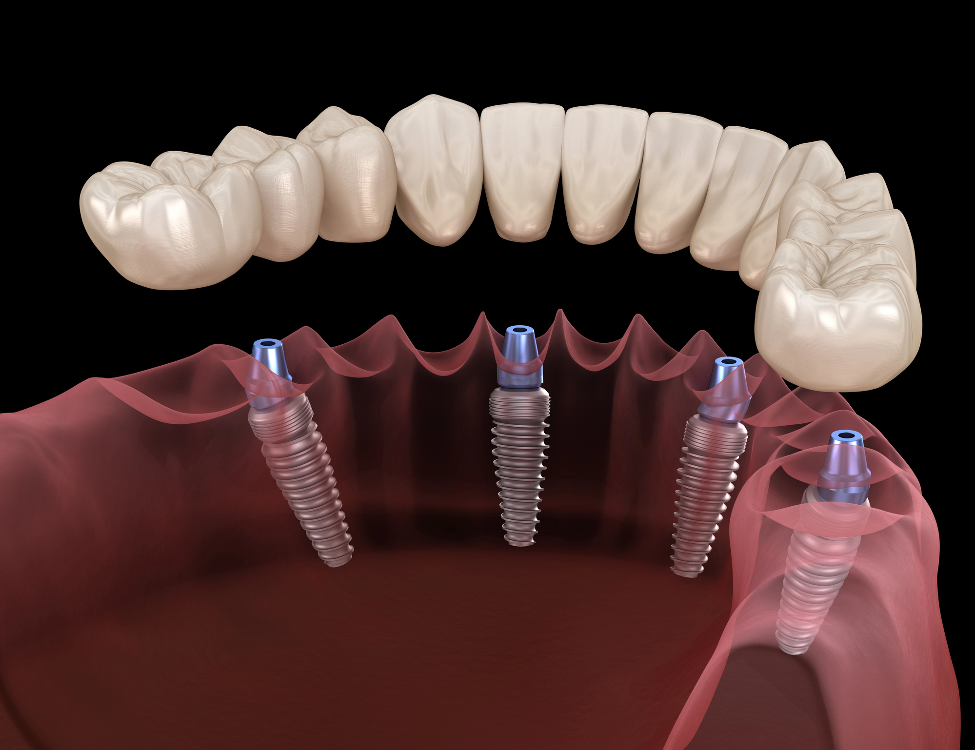 3d render of all on 4 dental implants Waxhaw NC