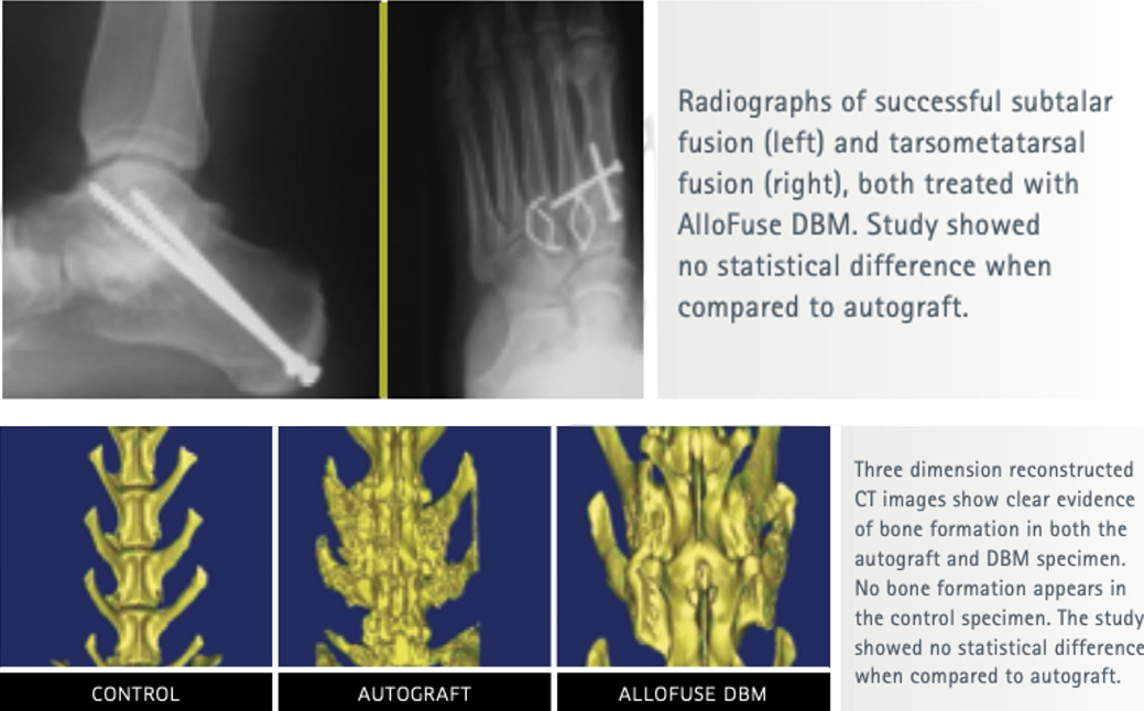 Moelleken M, Jockenhöfer F, Benson S, Dissemond J. Prospective clinical study on the efficacy of bacterial removal with mechanical debridement in and around chronic leg ulcers assessed with fluorescence imaging. Int Wound J. 2020 Aug;17(4):1011-1018.