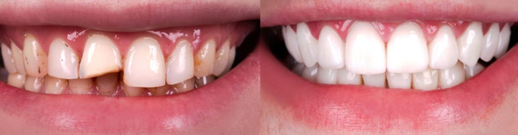 gum pain after veneers