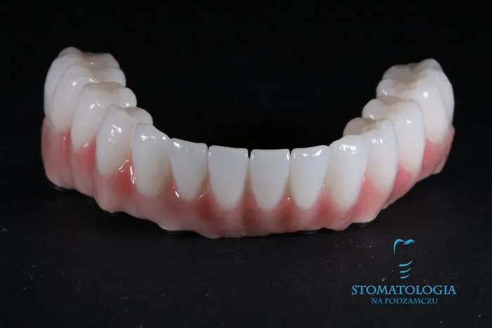 trwalosc-zebow-na-implantach-all-on-4