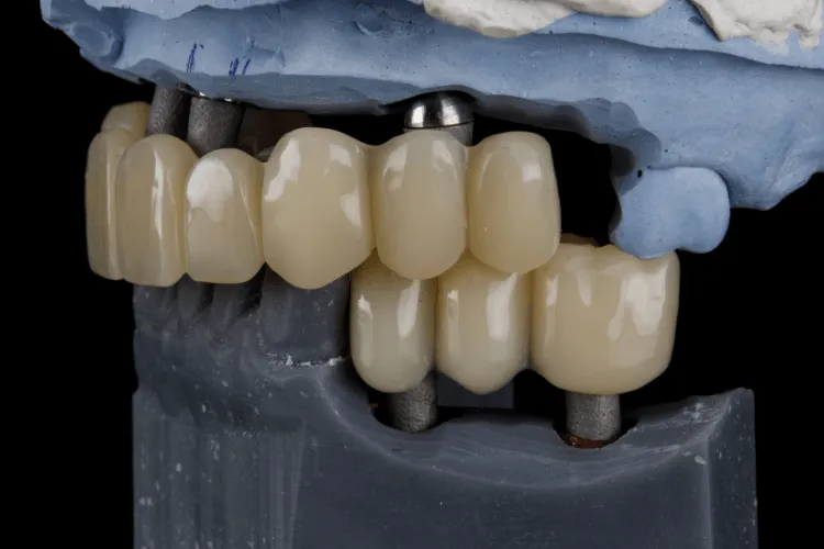 zabieg-all-on-4-w-opoznionej-odbudowie-po-ekstrakcji