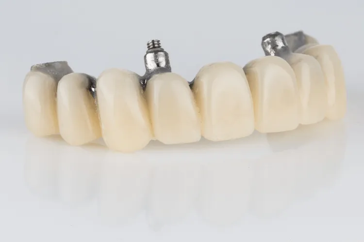 all-on-4-rekonstrukcja-luku-przy-znacznej-utracie-kosci