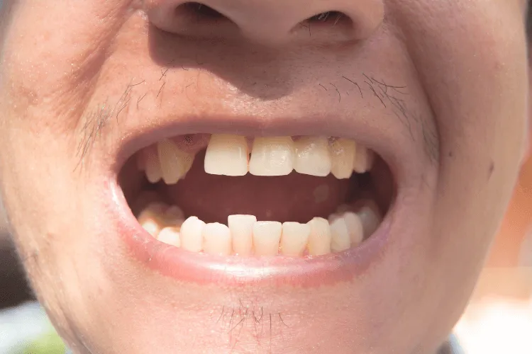 brak-zeba-zmiany-w-kosciach-szczeki-po-ekstrakcji