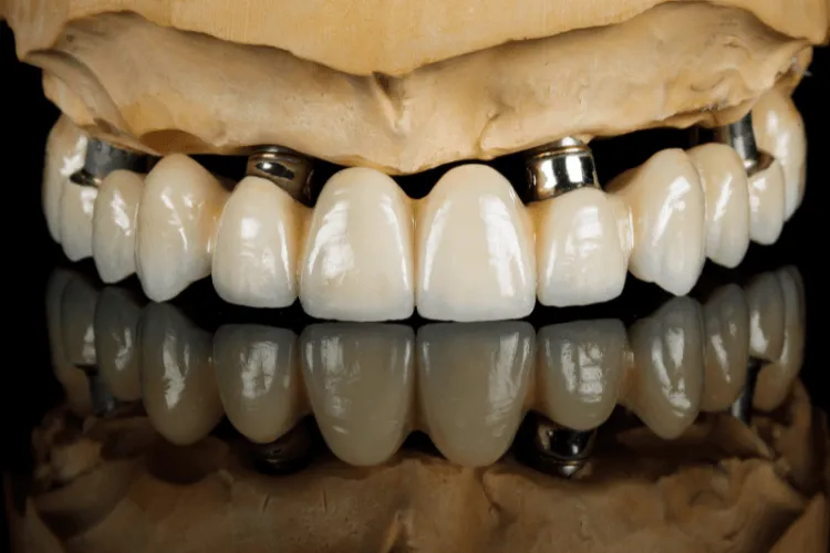 all-on-4-stabilizacja-protetyczna-przy-ubytkach-kosci