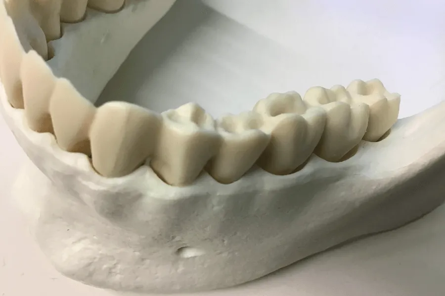 all-on-x-ograniczona-ilosc-kosci