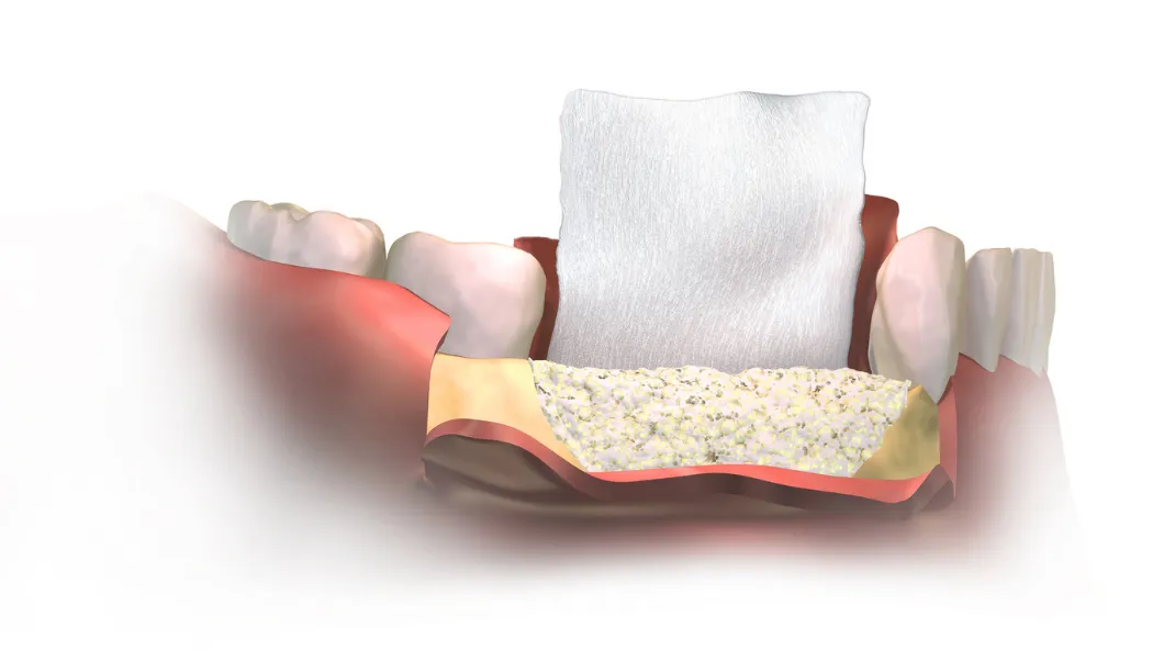 augumentacja-implantu