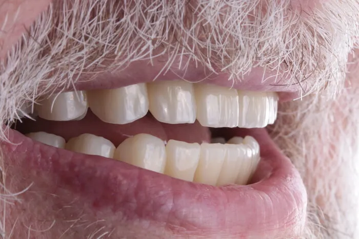 Uśmiech pacjenta po pełnej odbudowie uzębienia metodą All-on-4 na implantach