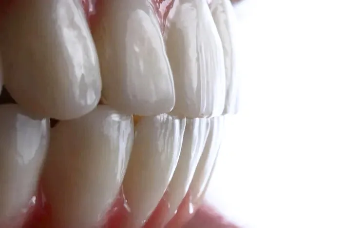 Zbliżenie odbudowy uzębienia wykonanej metodą All-on-4 na implantach