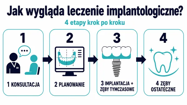 Infografika przedstawiająca 4 etapy leczenia All-on-4: konsultację, planowanie, implantację zębów tymczasowych oraz wykonanie zębów ostatecznych