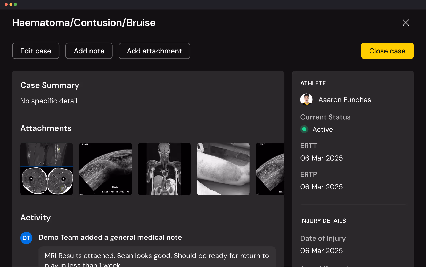 Medical case management interface showing Haematoma/Contusion/Bruise case with attachments including MRI images and a photo of bruised leg, athlete details, and medical notes.