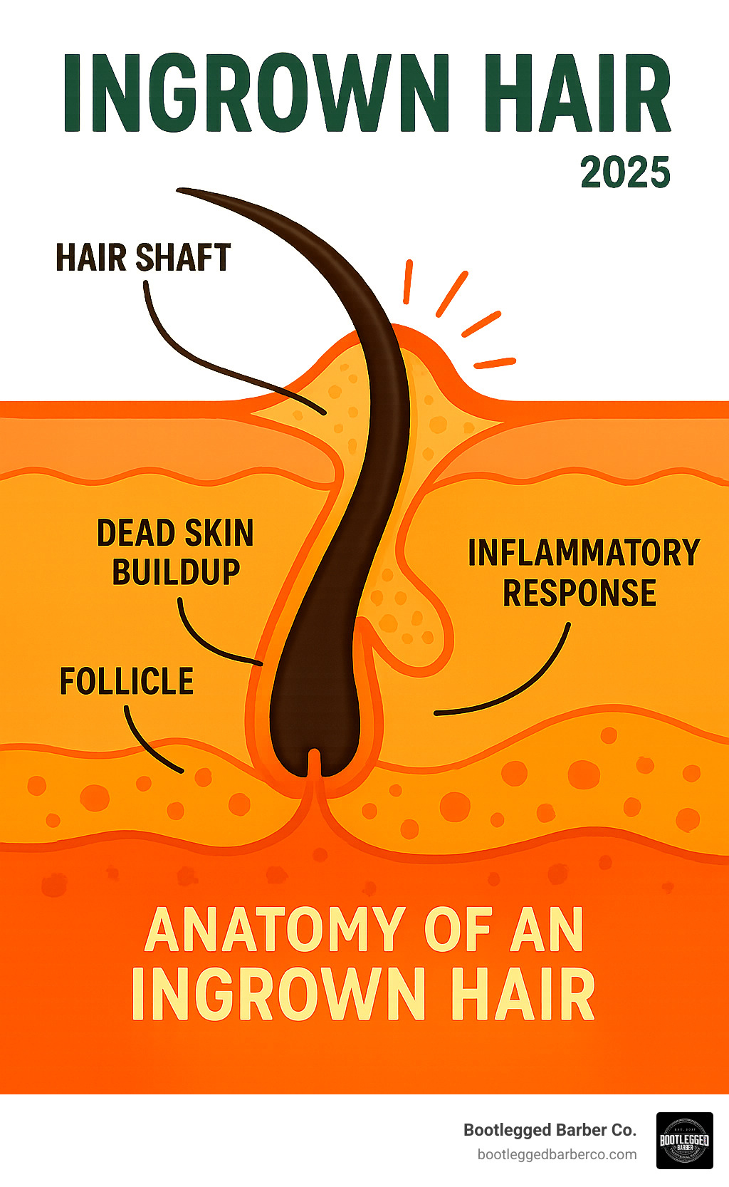 Detailed infographic showing the anatomy of an ingrown hair, illustrating how a hair follicle becomes clogged with dead skin cells, causing the hair to curl back into the skin and create inflammation, with labels for hair shaft, follicle, dead skin buildup, and inflammatory response - Ingrown hair prevention infographic 