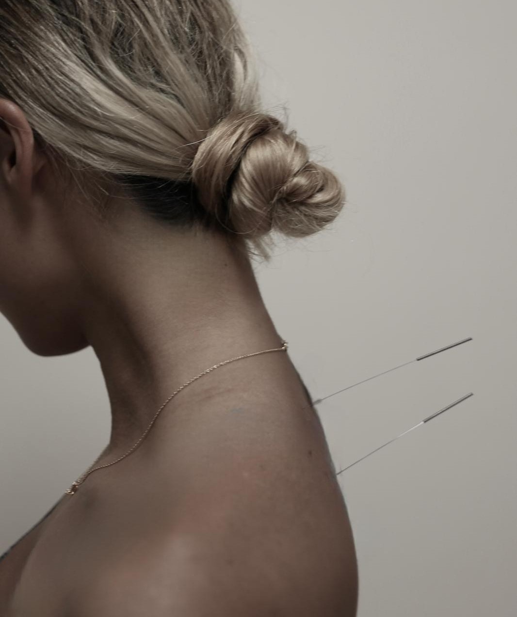 Acupuncture treatment at Qin's Clinic