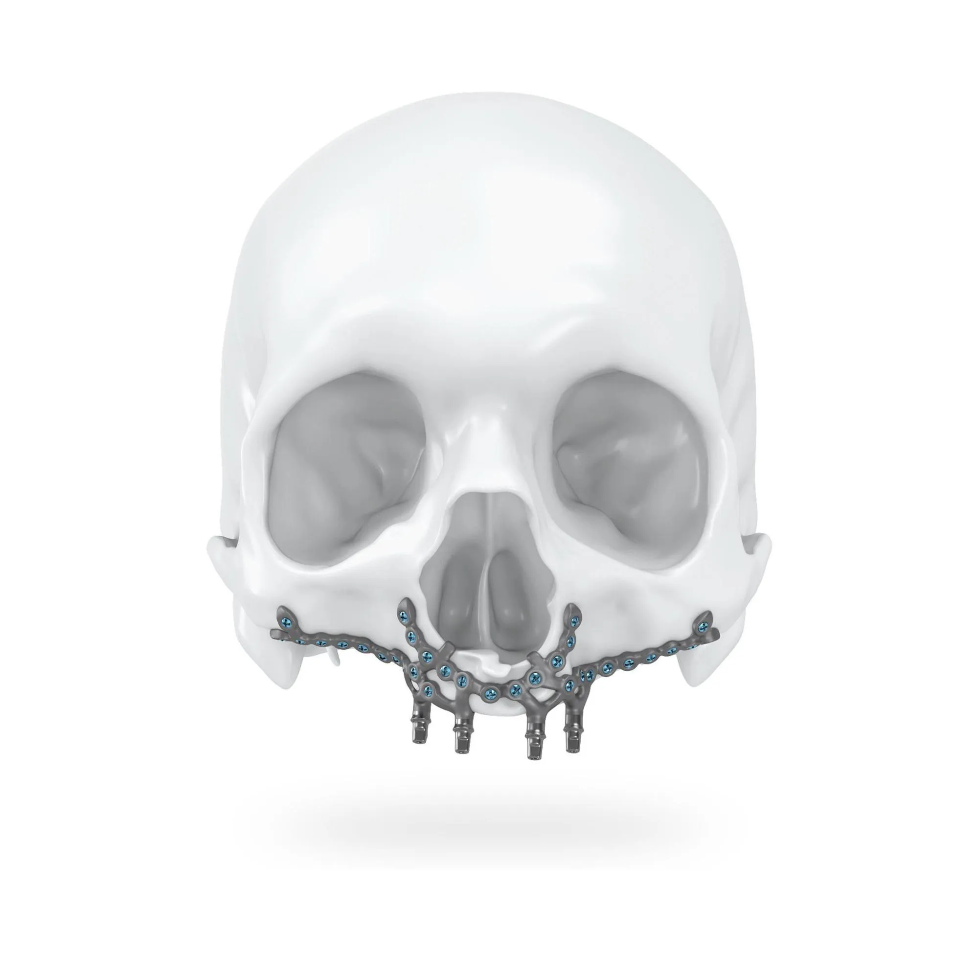 PSI passt sich als Maßimplantat der individuellen Knochenform an