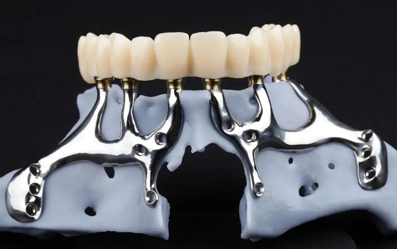 PSI-Anwendung bei stark atropher Maxilla