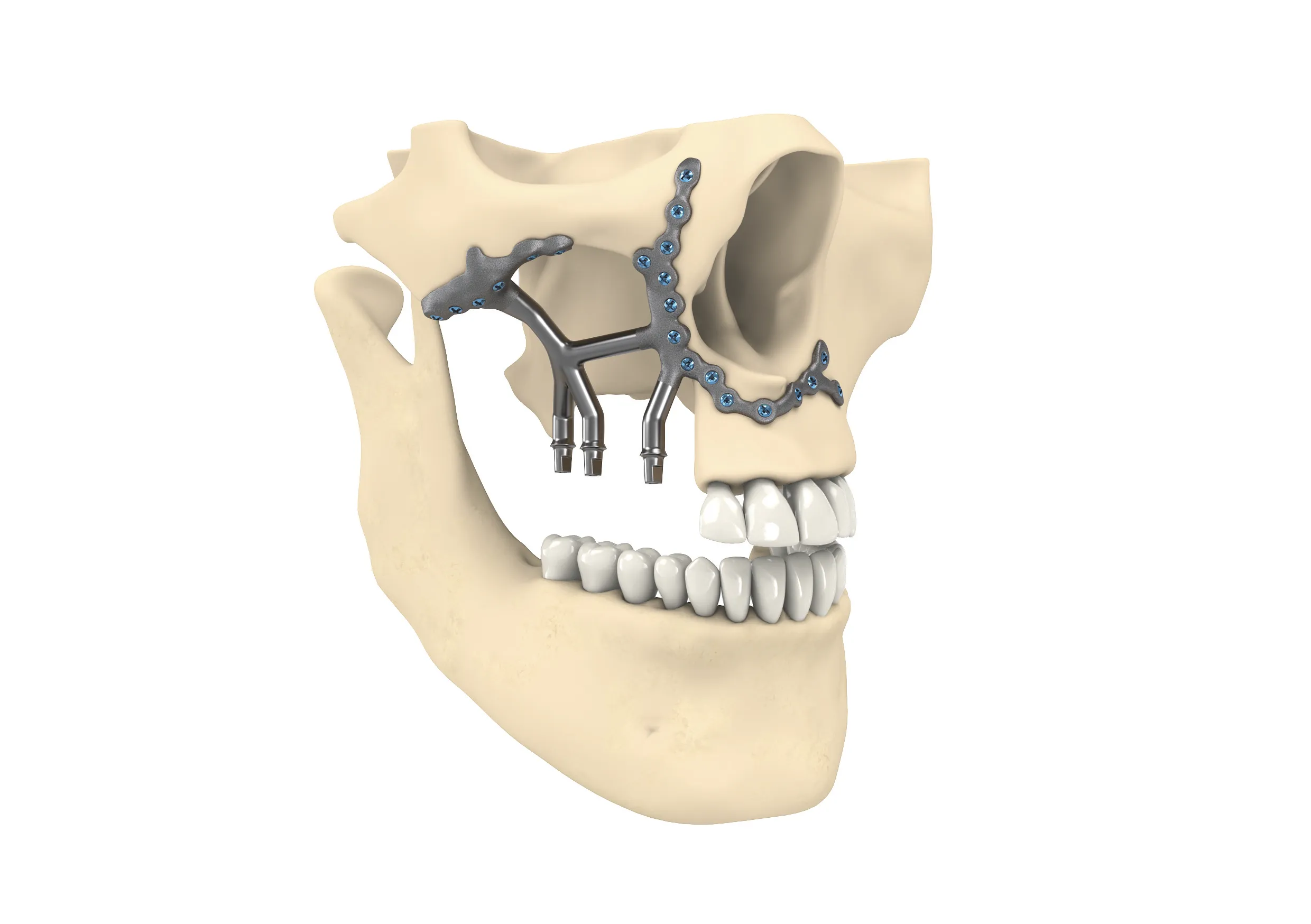 Virtuelle OP-Planung eines patientenspezifischen Implantats