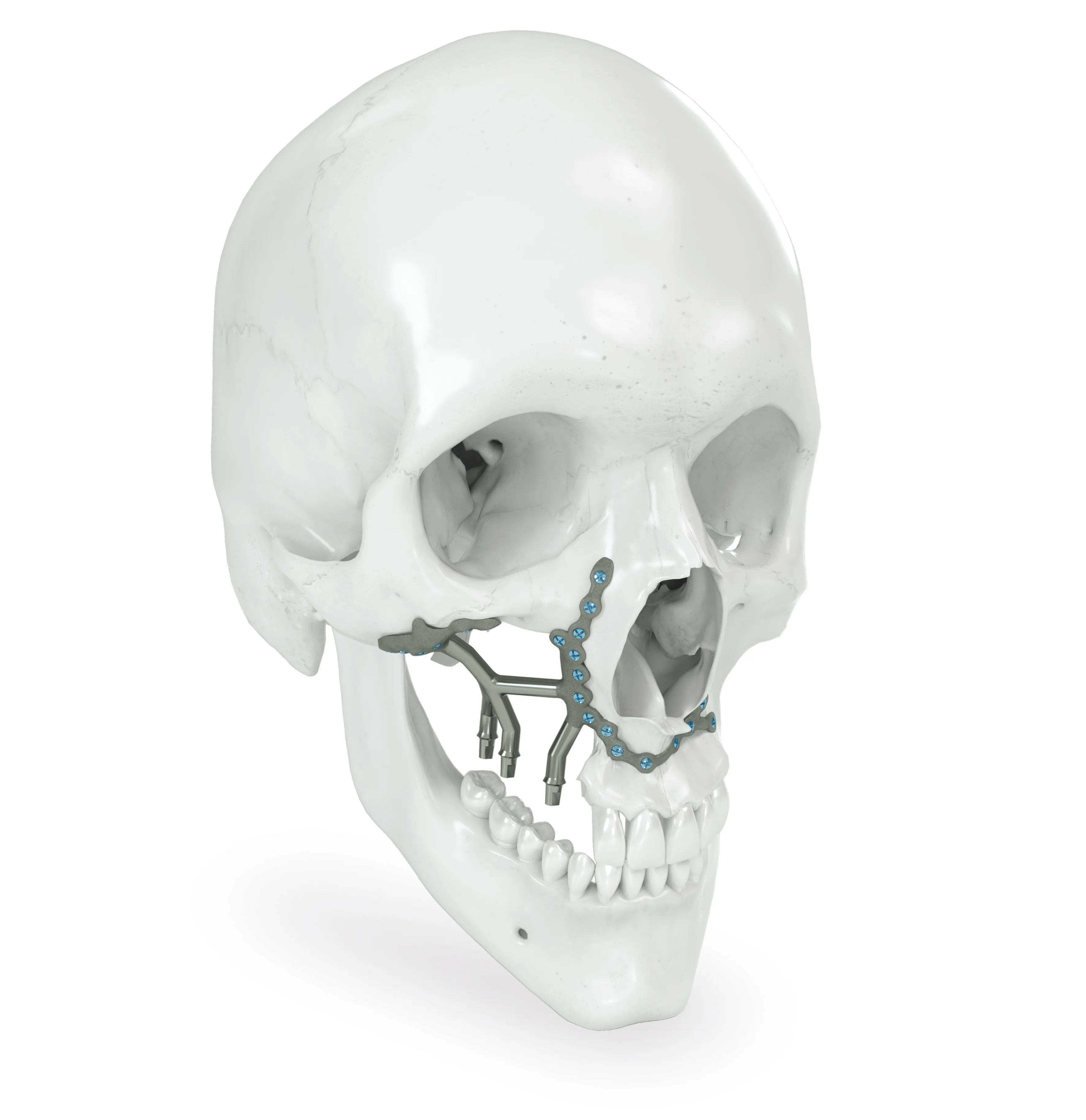 3D-Visualisierung eines individuellen subperiostalen Implantats