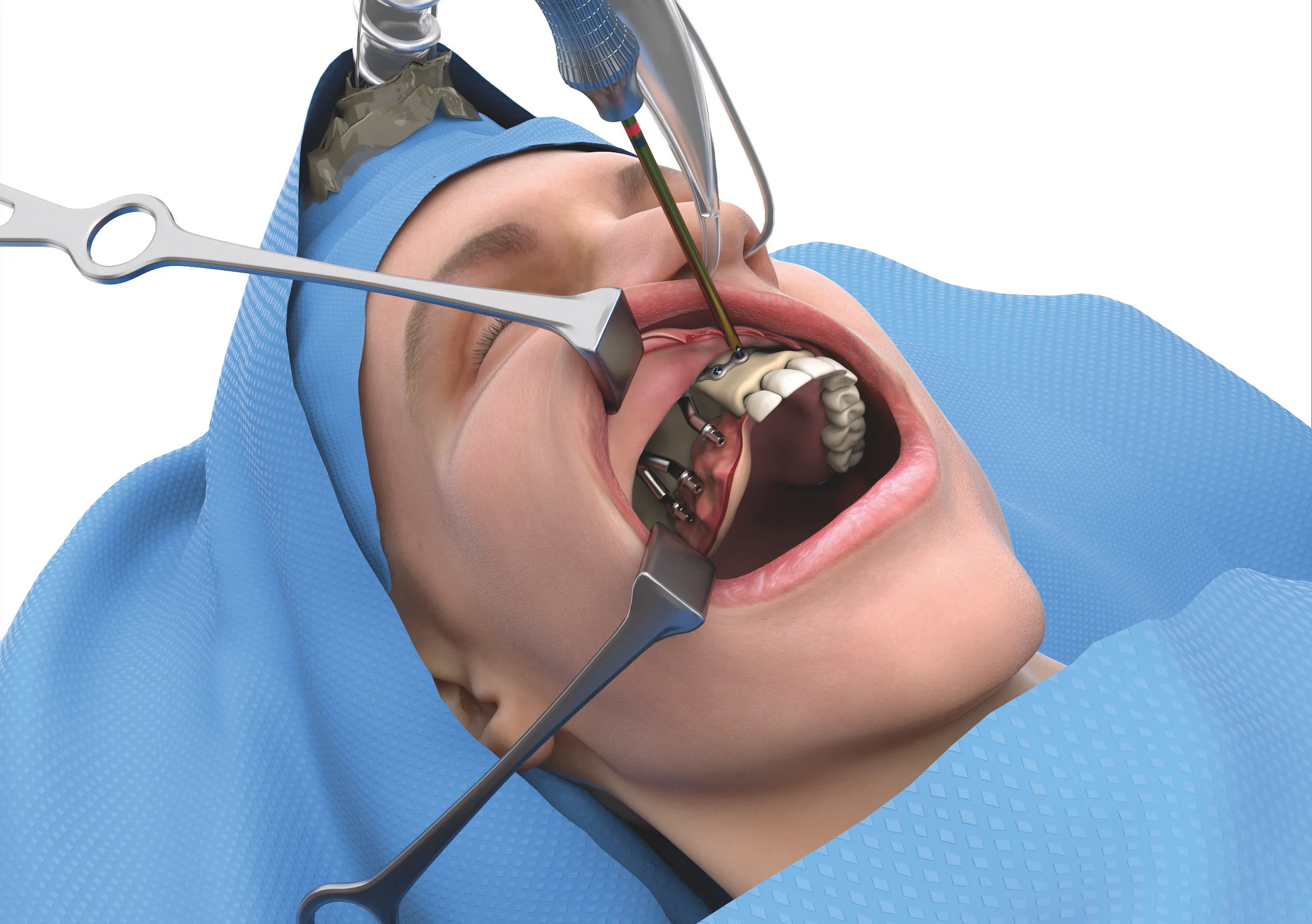 Fixierung eines subperiostalen Implantats während der OP