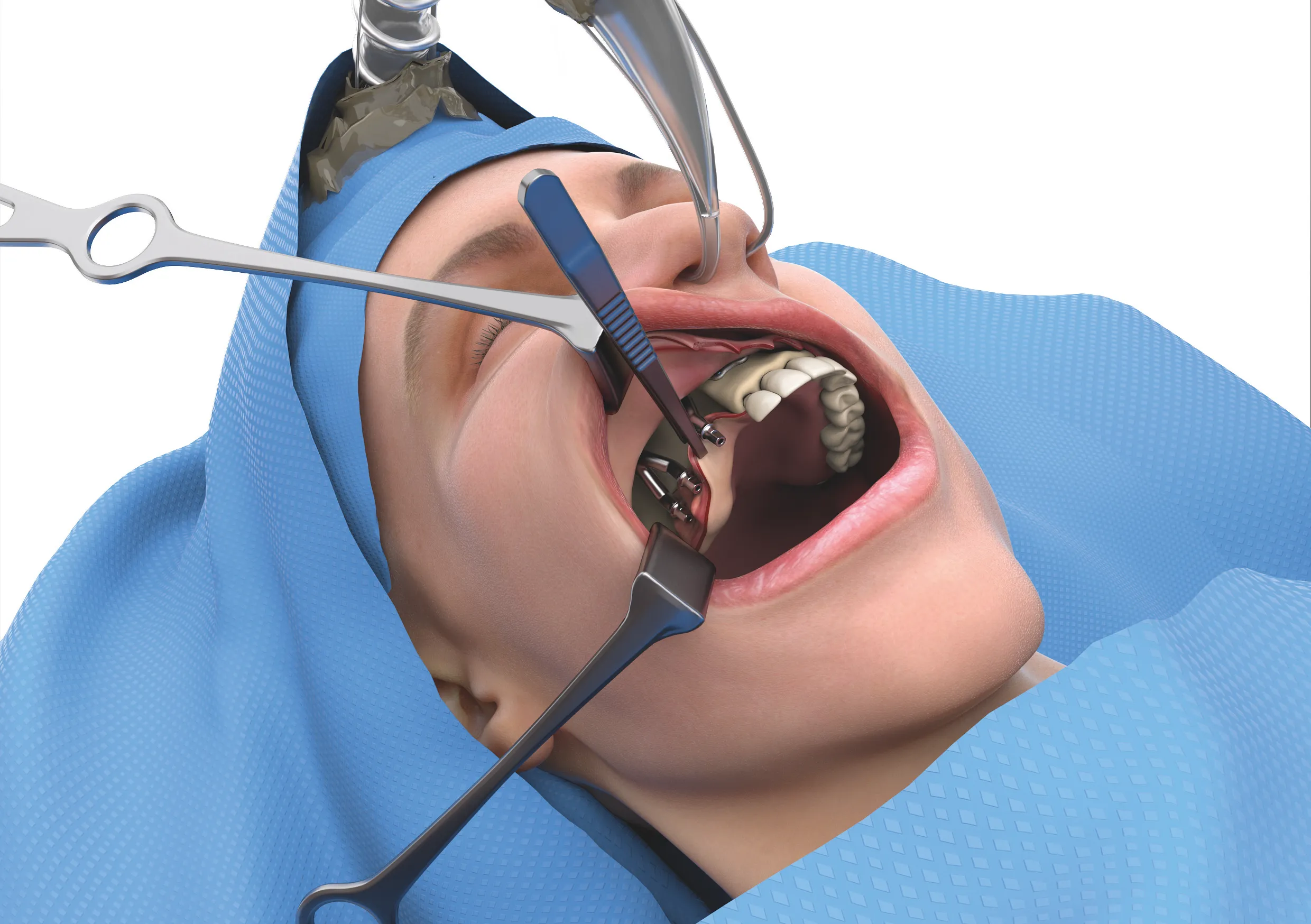 Chirurgisches Anlegen der Durchtritte für die Implantatpfosten