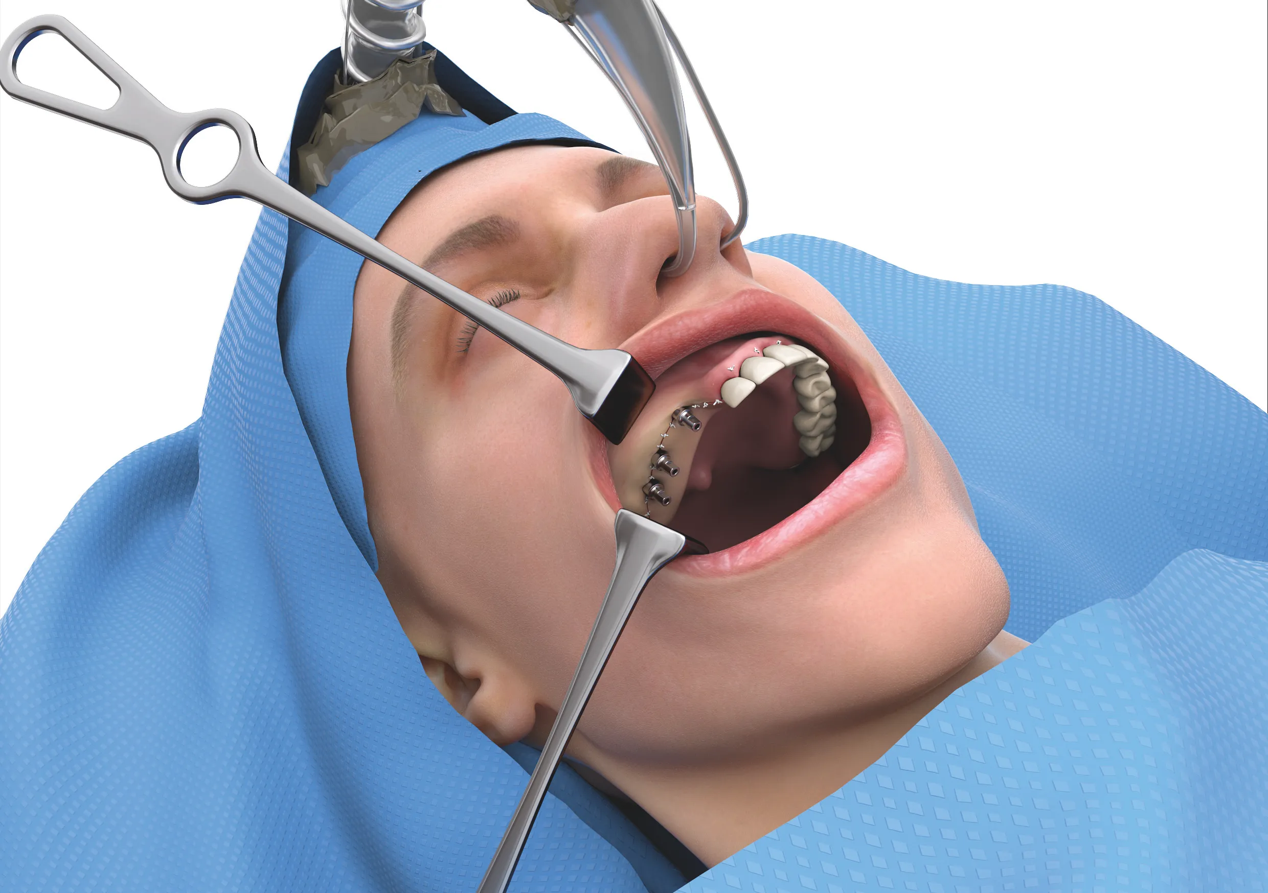 Digitale finale Versorgung mit prothetischem Aufbau