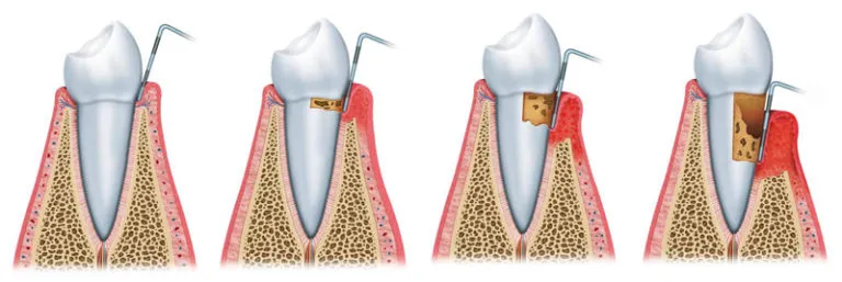 different 4 stages of gum disease