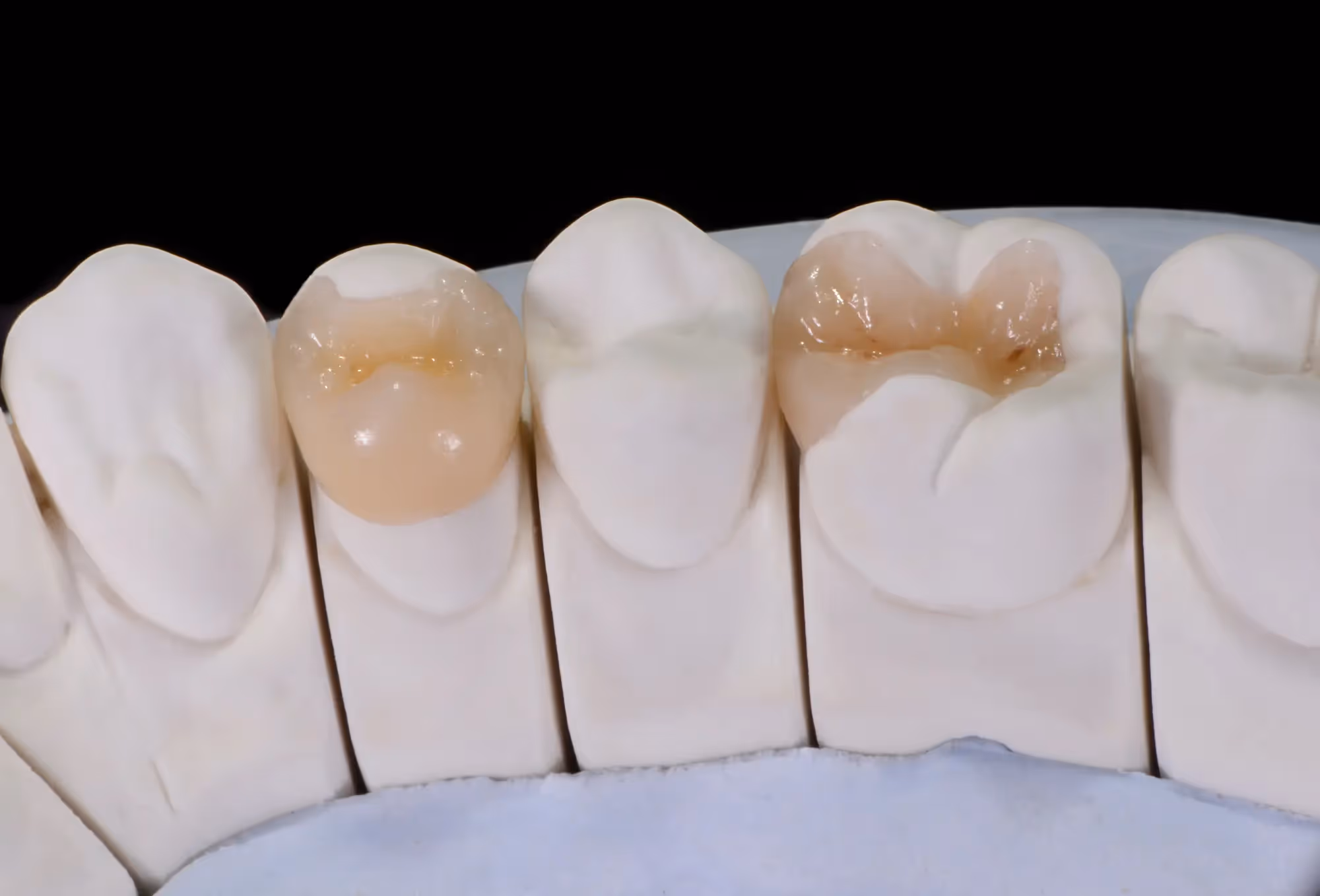 Pediatric Restorative Dentistry in Springfield