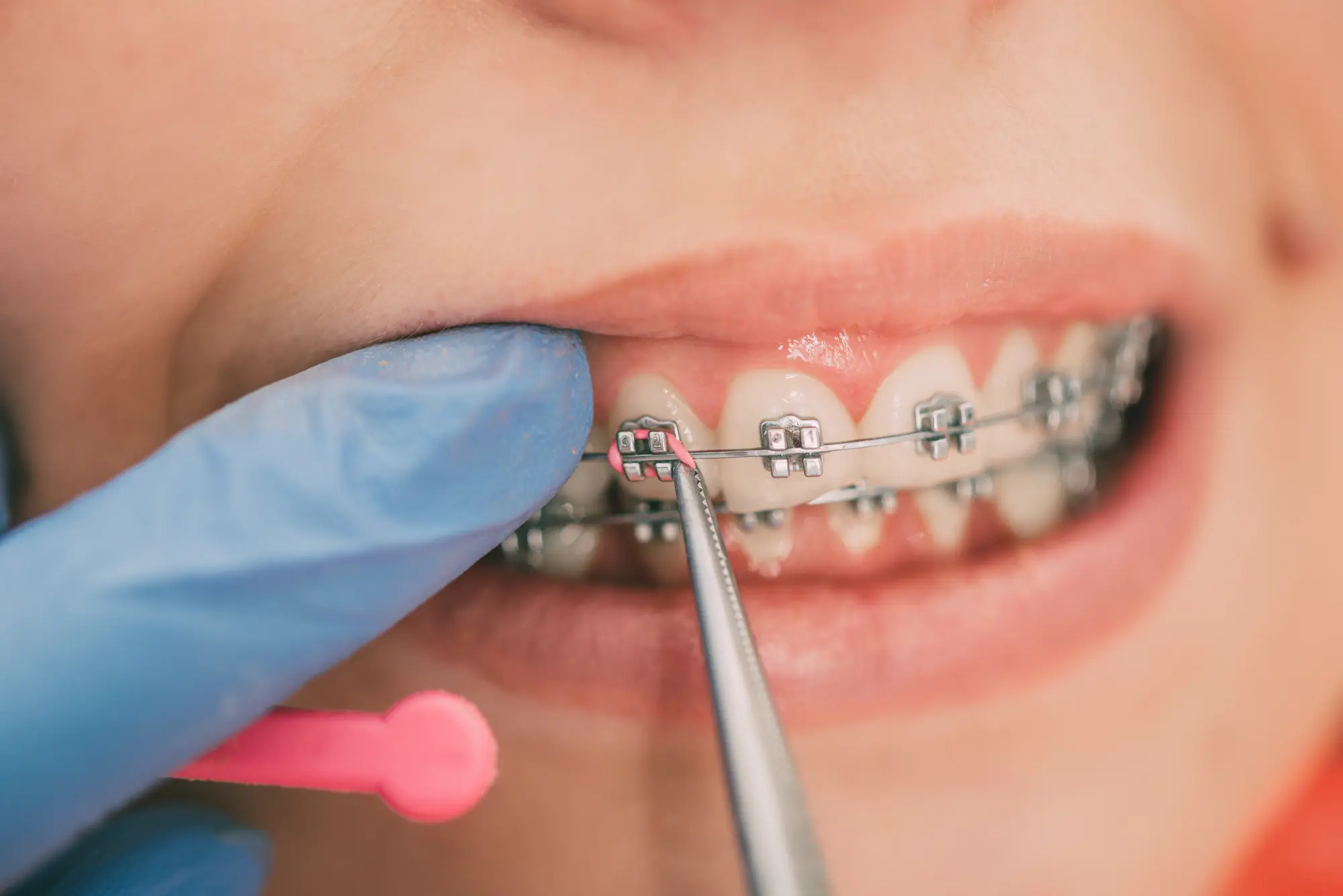 Braces in Spring