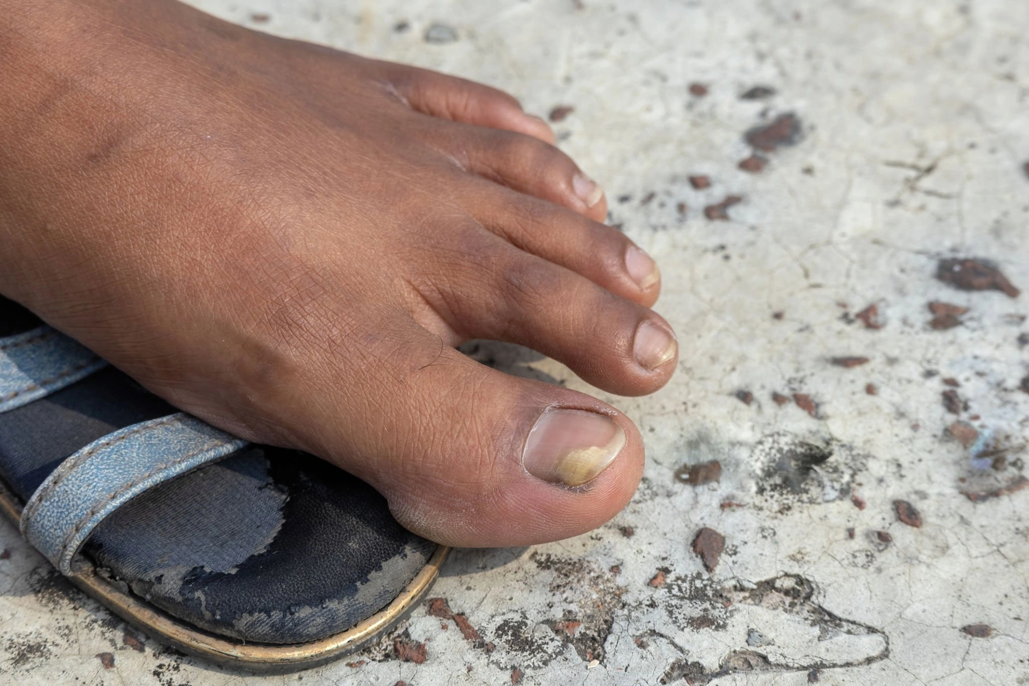 Yellow and discolored toenail showing symptoms of fungal infection
