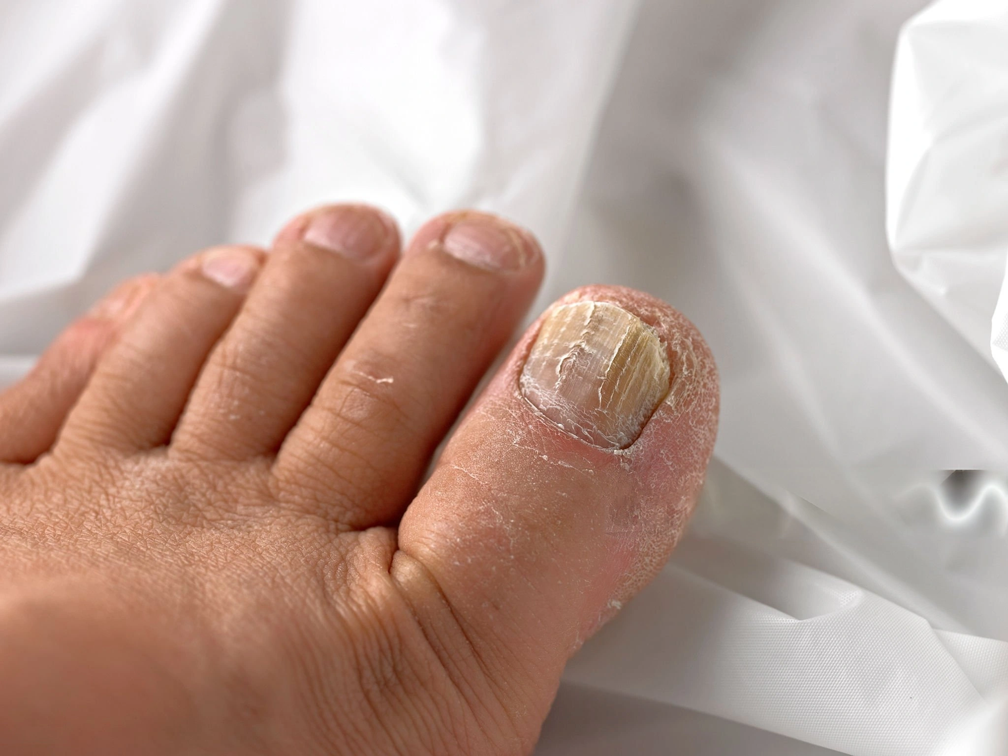 Thickened and discolored toenail showing signs of toenail fungus