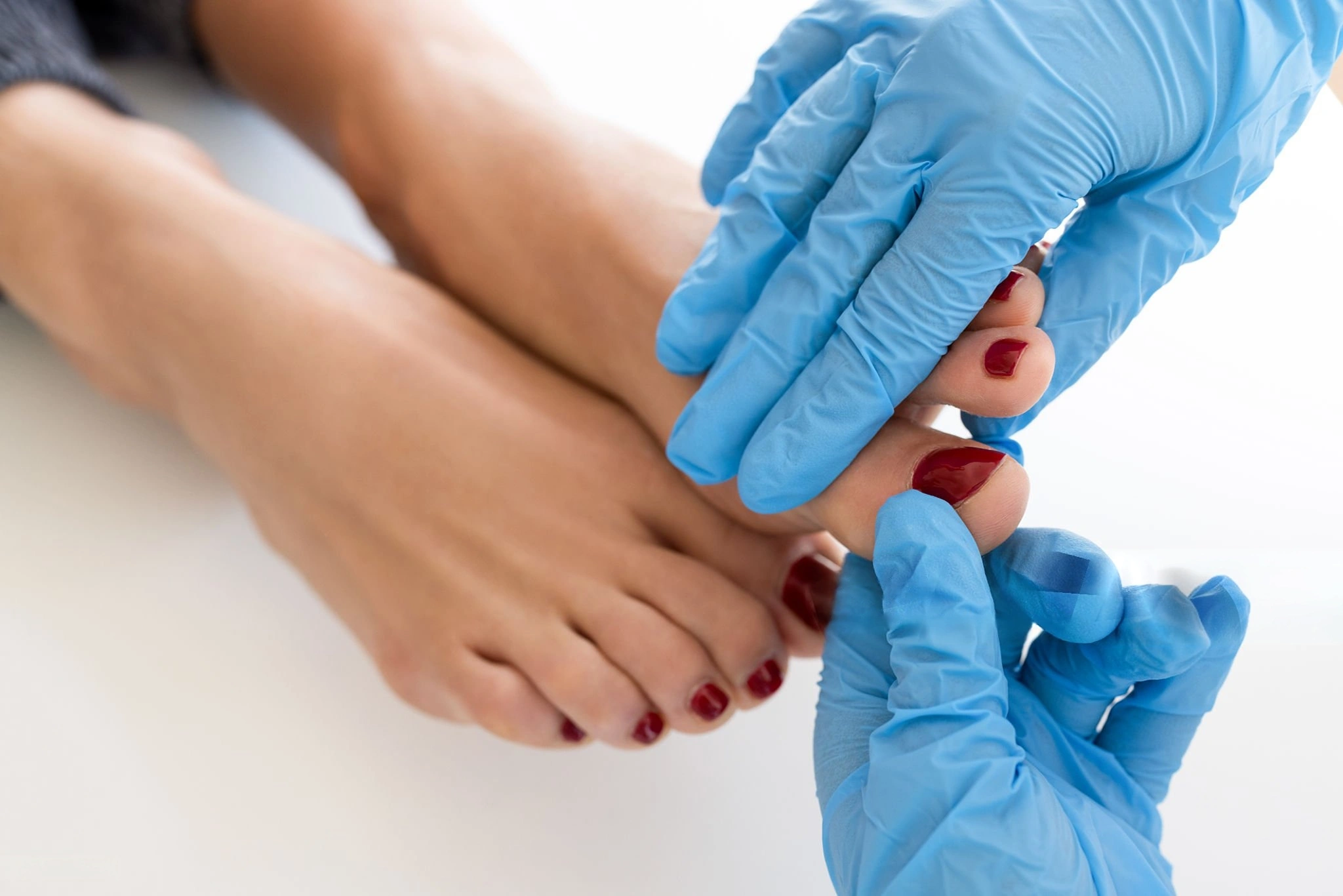 Toenail fungus treatment showing a healthcare professional examining a toenail