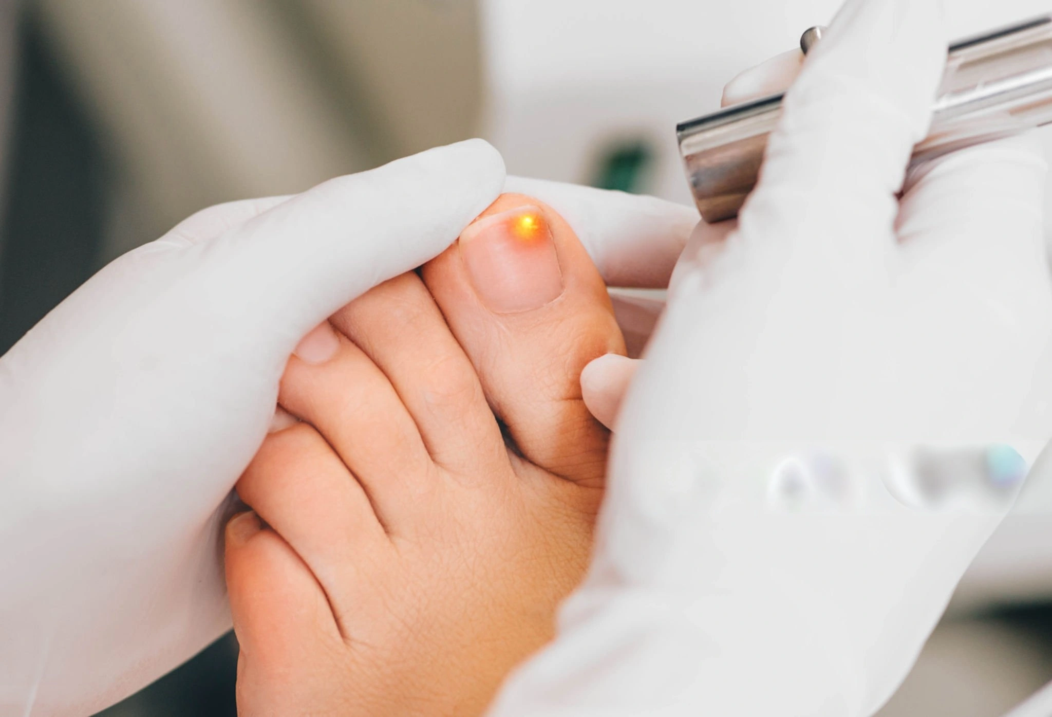 Healthcare professional examining a toenail with suspected fungal infection using laser treatment