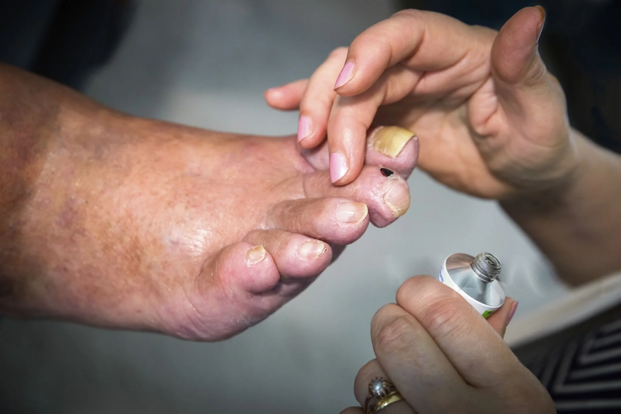 toenail fungus medication