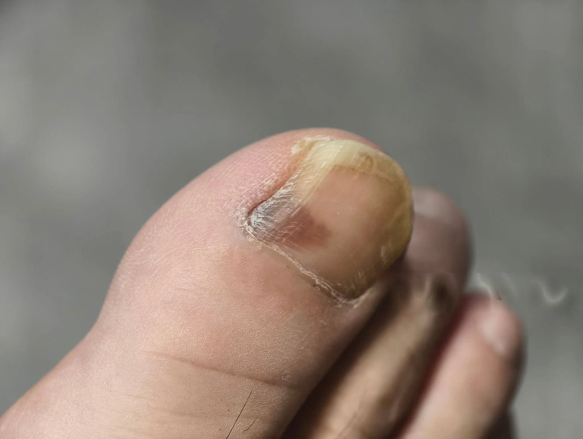 Athlete's foot can spread