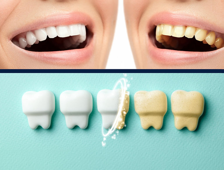 3 Types of Professional Teeth Whitening Treatments