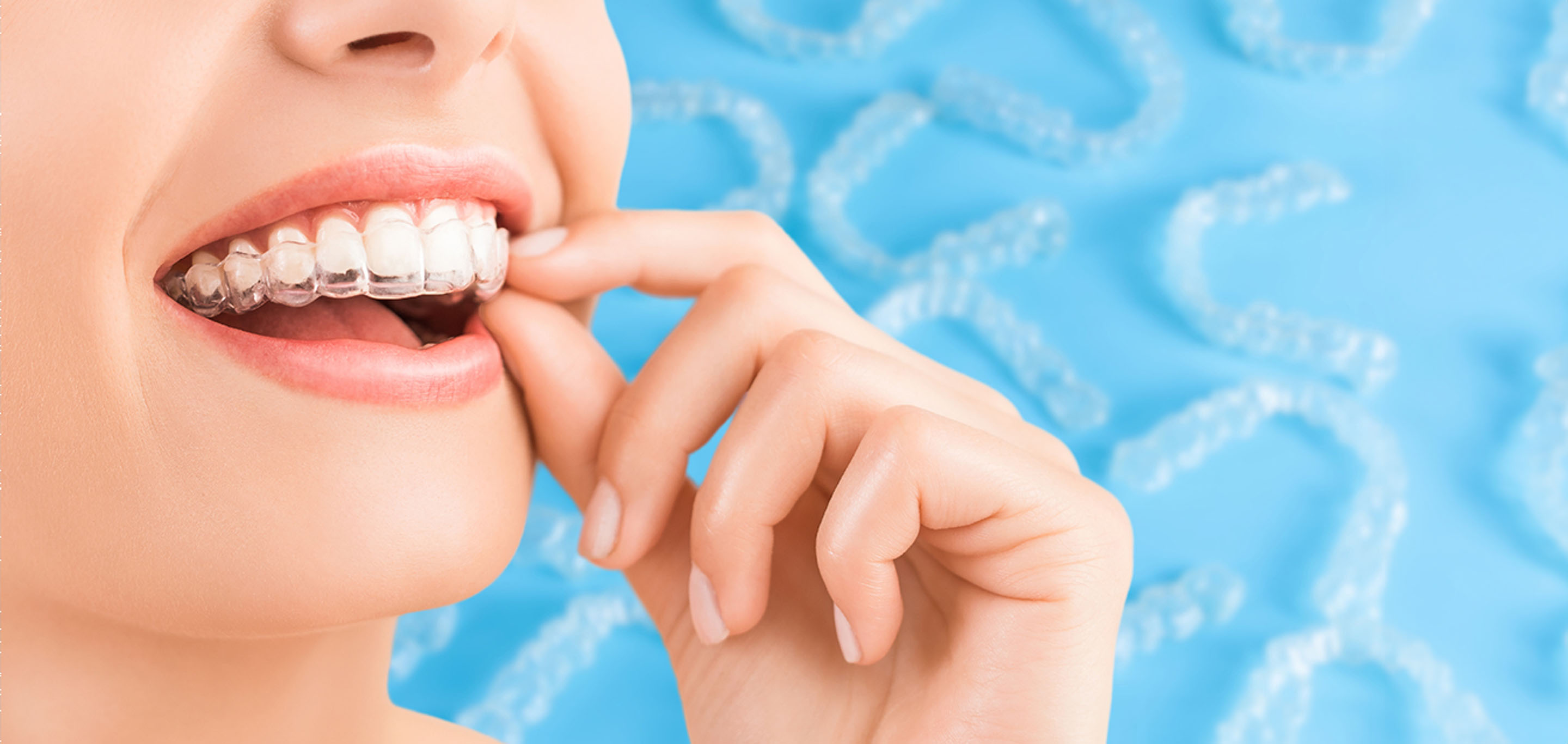 Invisalign: A Step-by-Step Guide