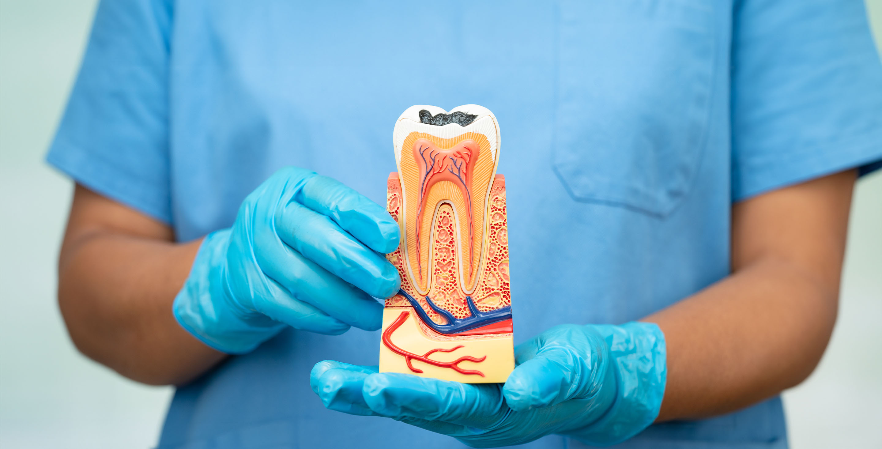 Root Canal Therapy in Kanata