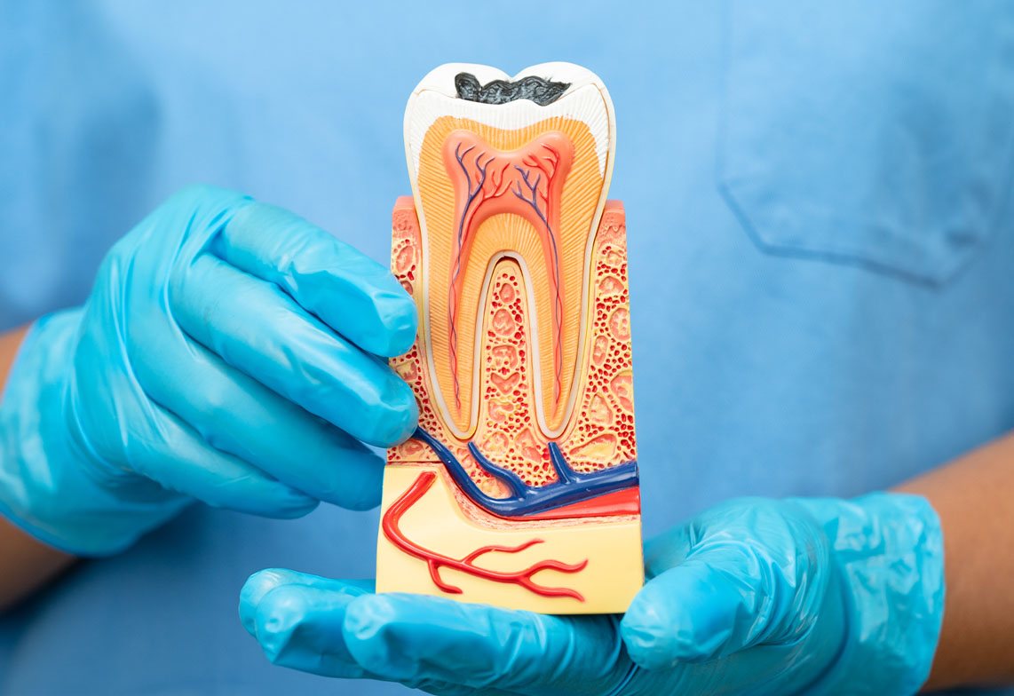 Root Canal Therapy in Kanata