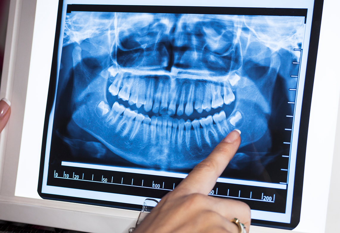 Wisdom teeth removal in Kanata