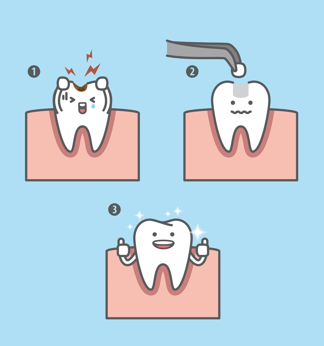 How dental fillings work by Dentistry@Kanata