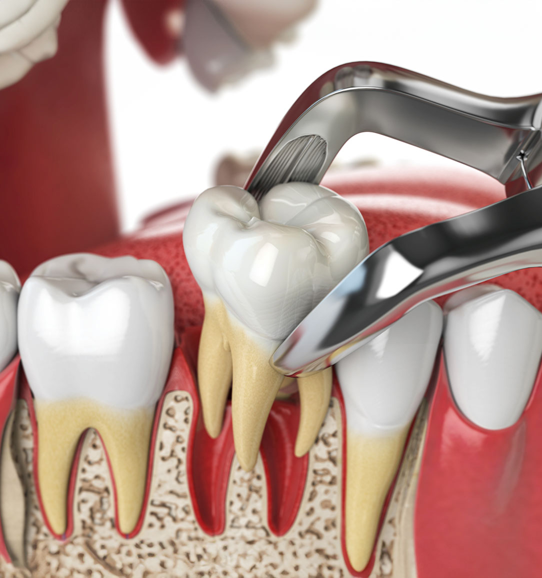 How teeth are extracted medical Dentistry