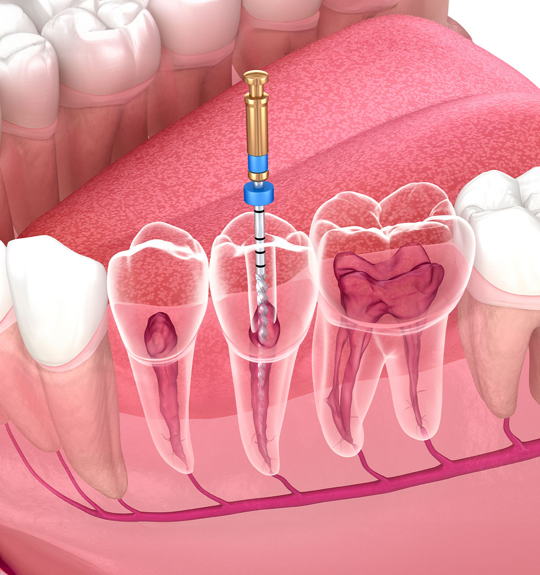 Cutting edge root canal therapy at Dentistry@Kanata