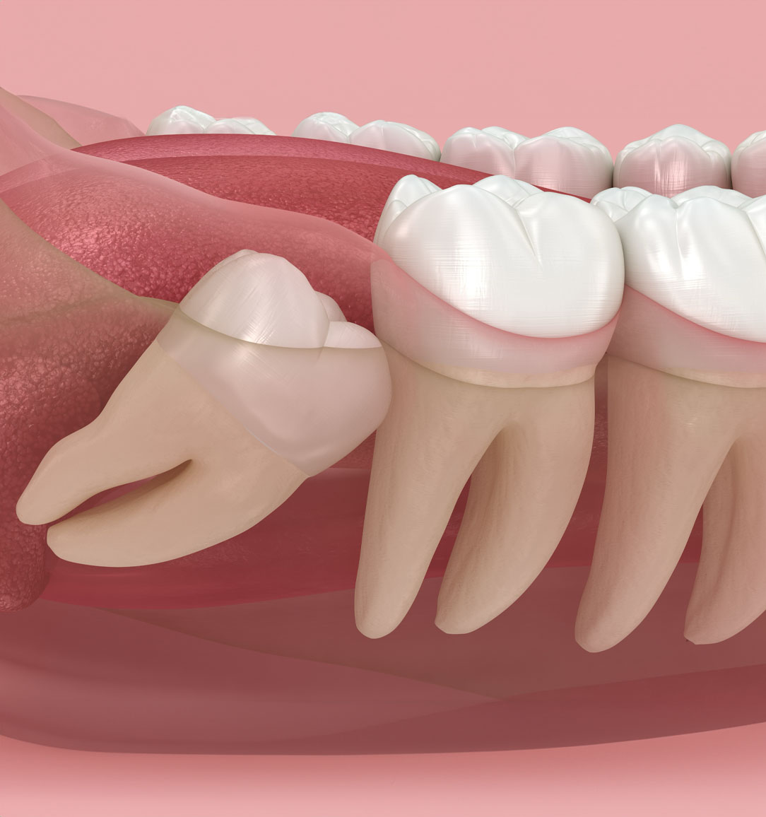 Expert Wisdom teeth removal