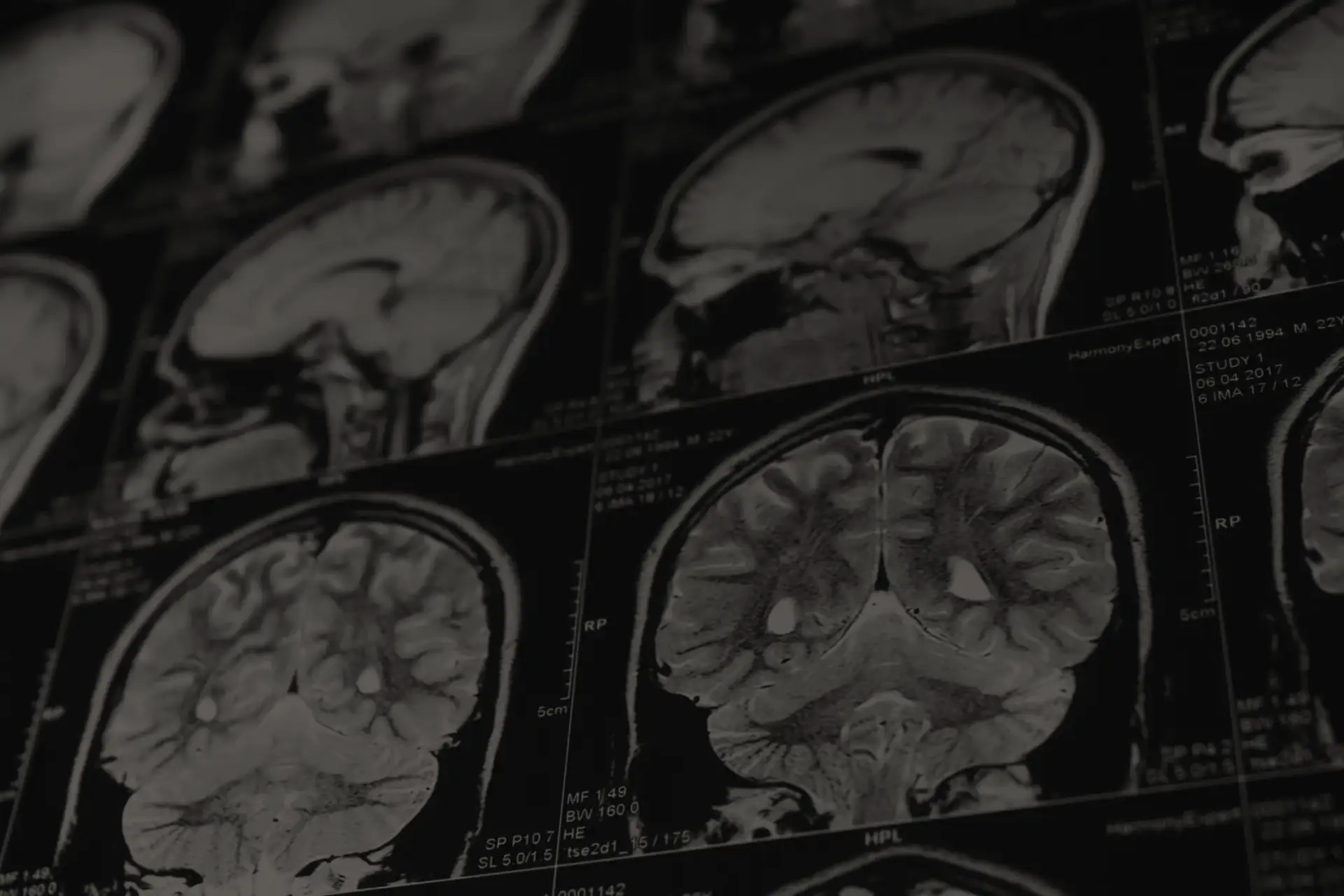 Black and white MRI brain scans showing various cross-sectional views of the brain tissue.