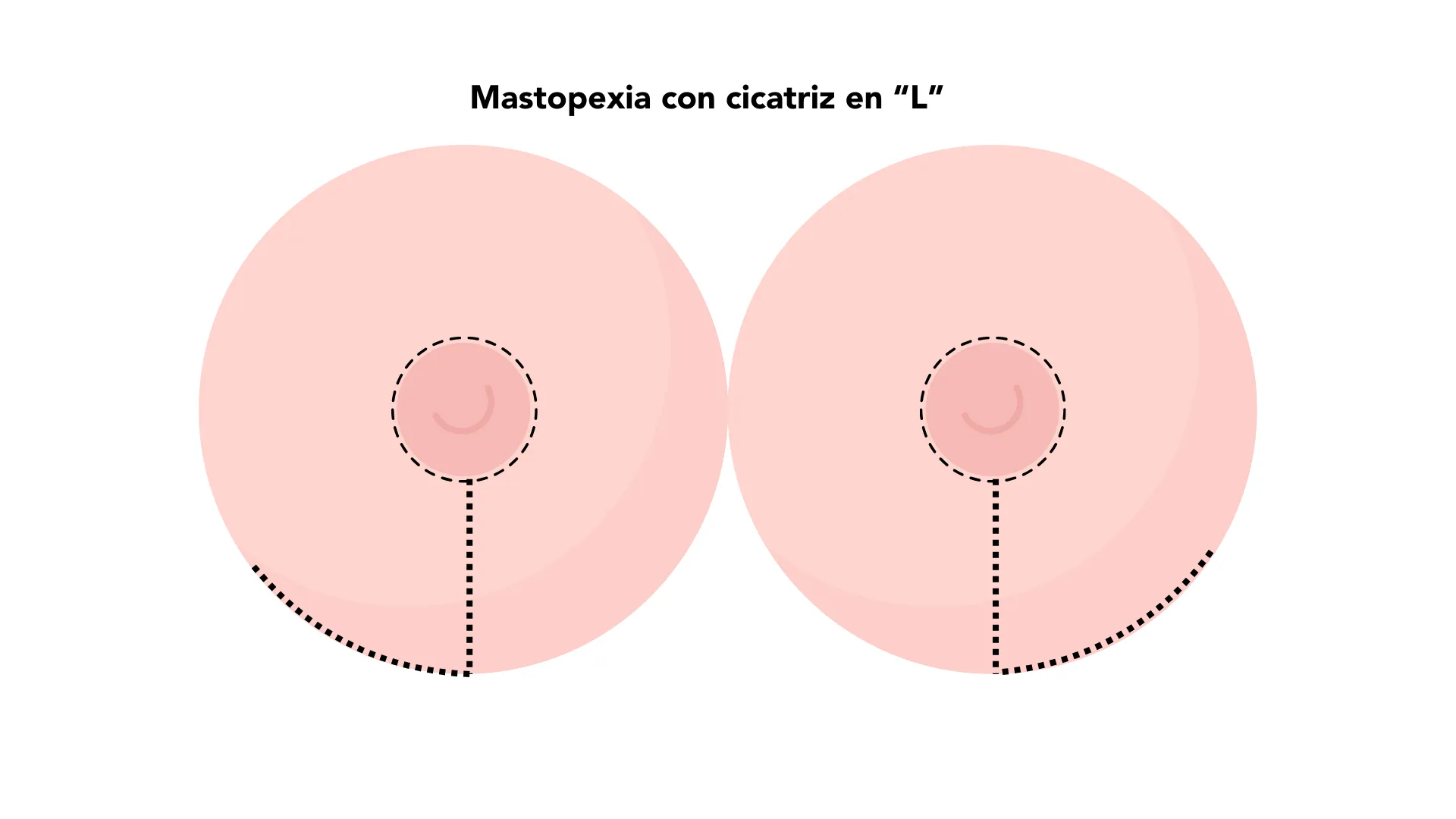mastopexia con cicatriz en L