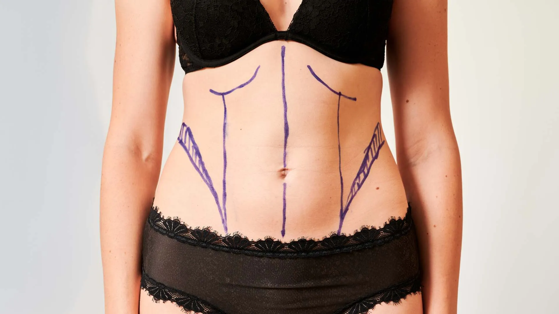 ¿Cuál es la diferencia entre una liposucción convencional y una liposucción asistida por tecnología?