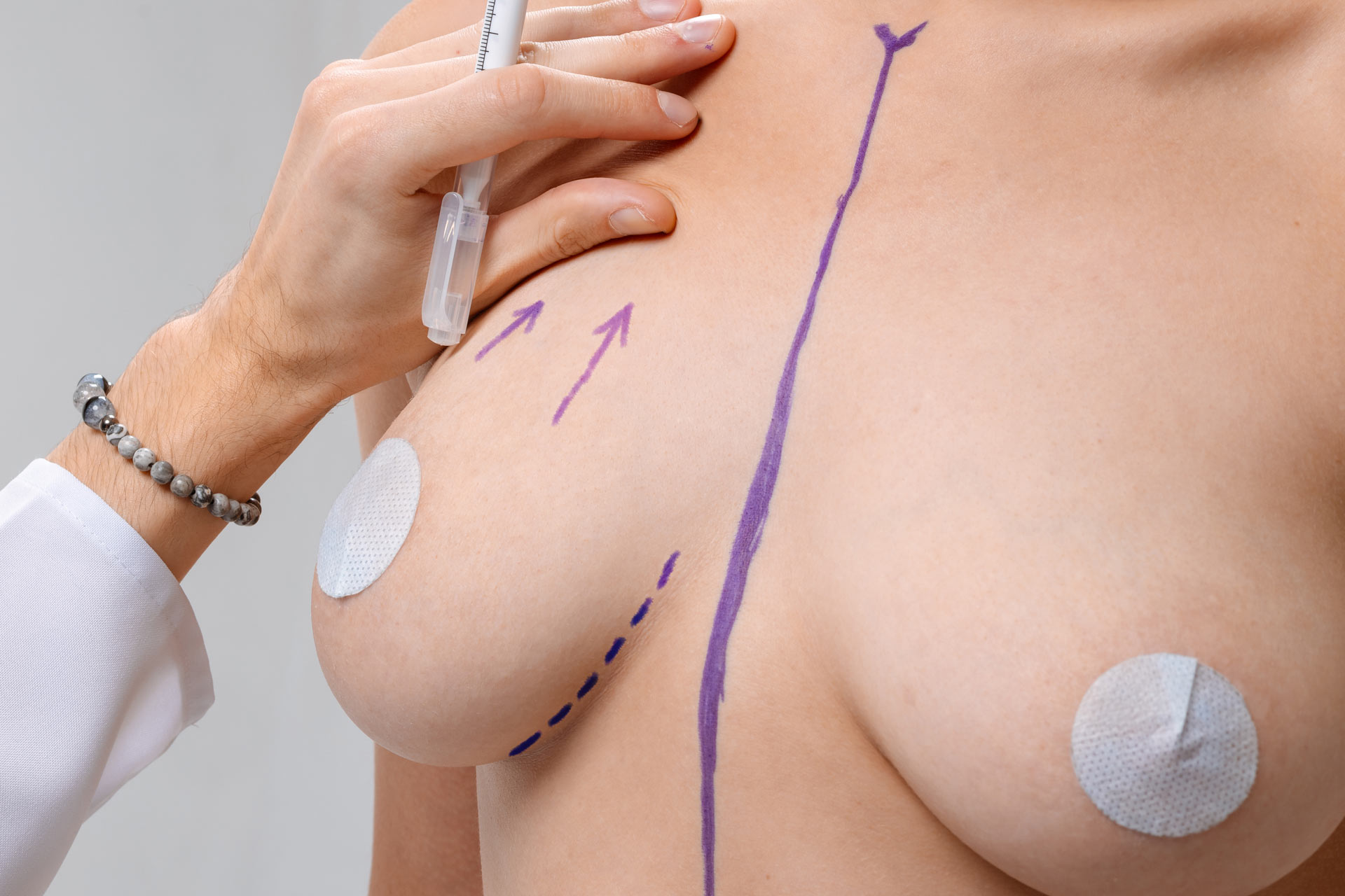 ¿Es lo mismo un levantamiento de senos que una mamoplastia reductora?